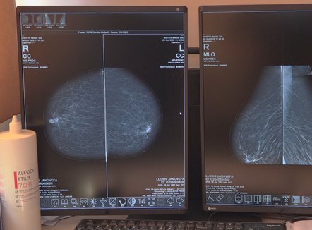 Kanceri si epidemi, mbi 7 mijë raste të reja në vit, meshkujt më të prekurit