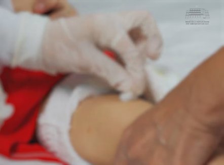 Heshtën kur shpërthyen rastet e fruthit, Shqipëria humb statusin si vend pa fruth, tani thirrje për vaksinim