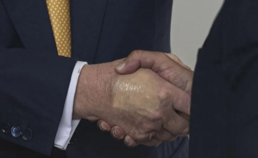 Shtëpia e Bardhë zbulon sëmundjen nga se vuan Donald Trump