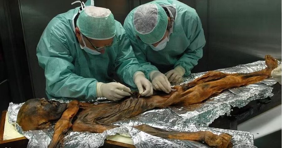 Zbulohet se mumia &Ouml;tzi ishte e infektuar me papilloma virus