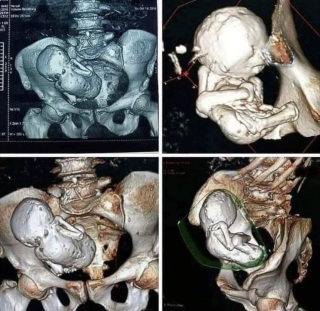 Skaneri zbulon fetus t&euml; kalcifikuar 30-vje&ccedil;ar n&euml; trupin e