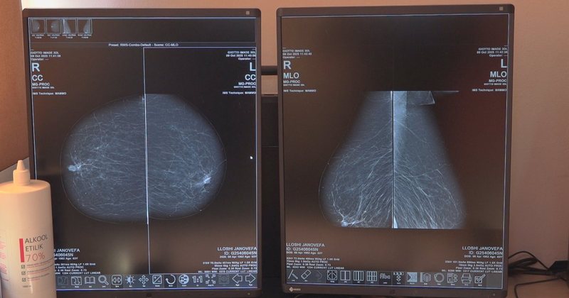 Kanceri si epidemi, mbi 7 mij&euml; raste t&euml; reja n&euml; vit, meshkujt