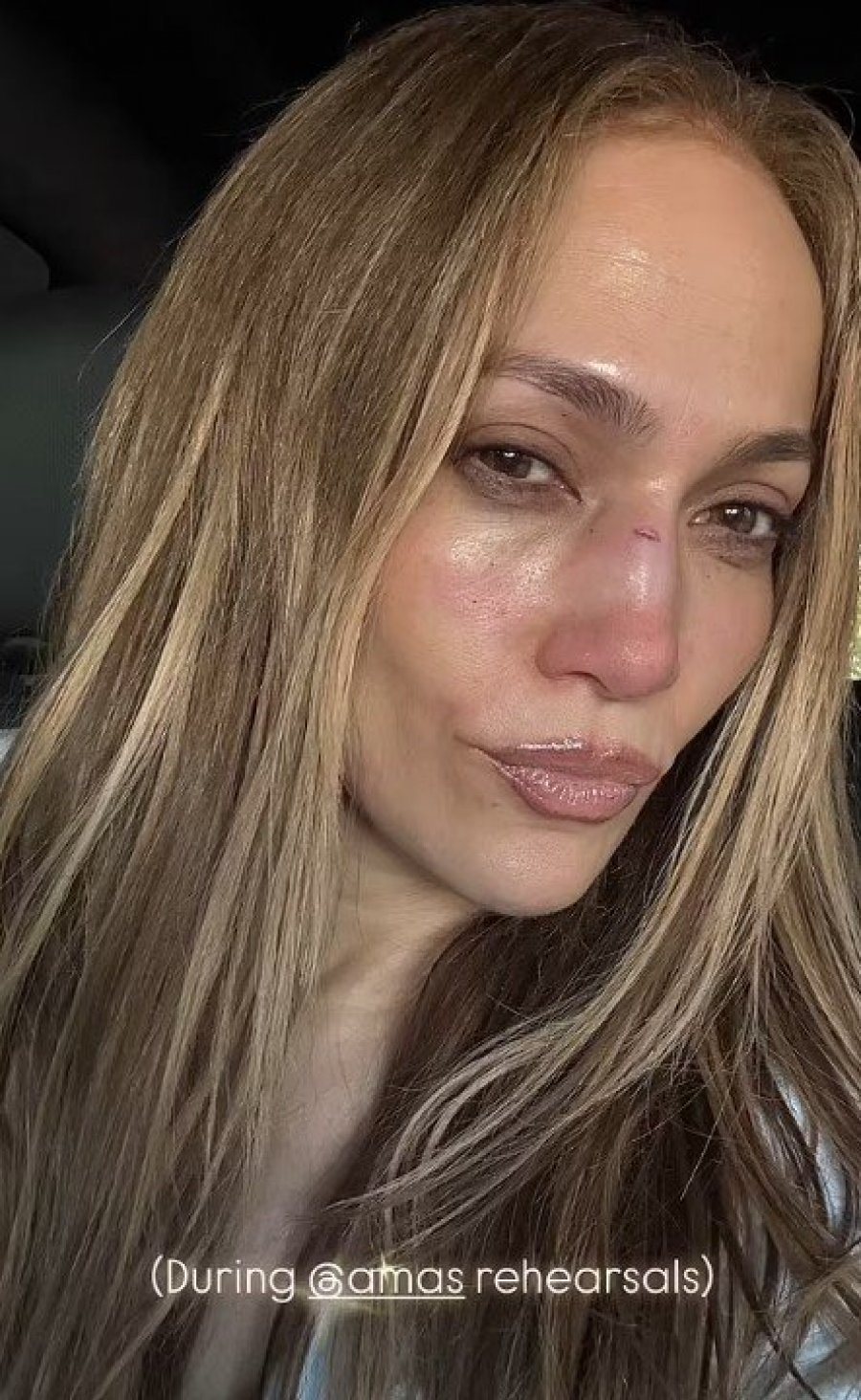 JLo pëson dëmtim të rëndë në fytyrë, rrezikon
