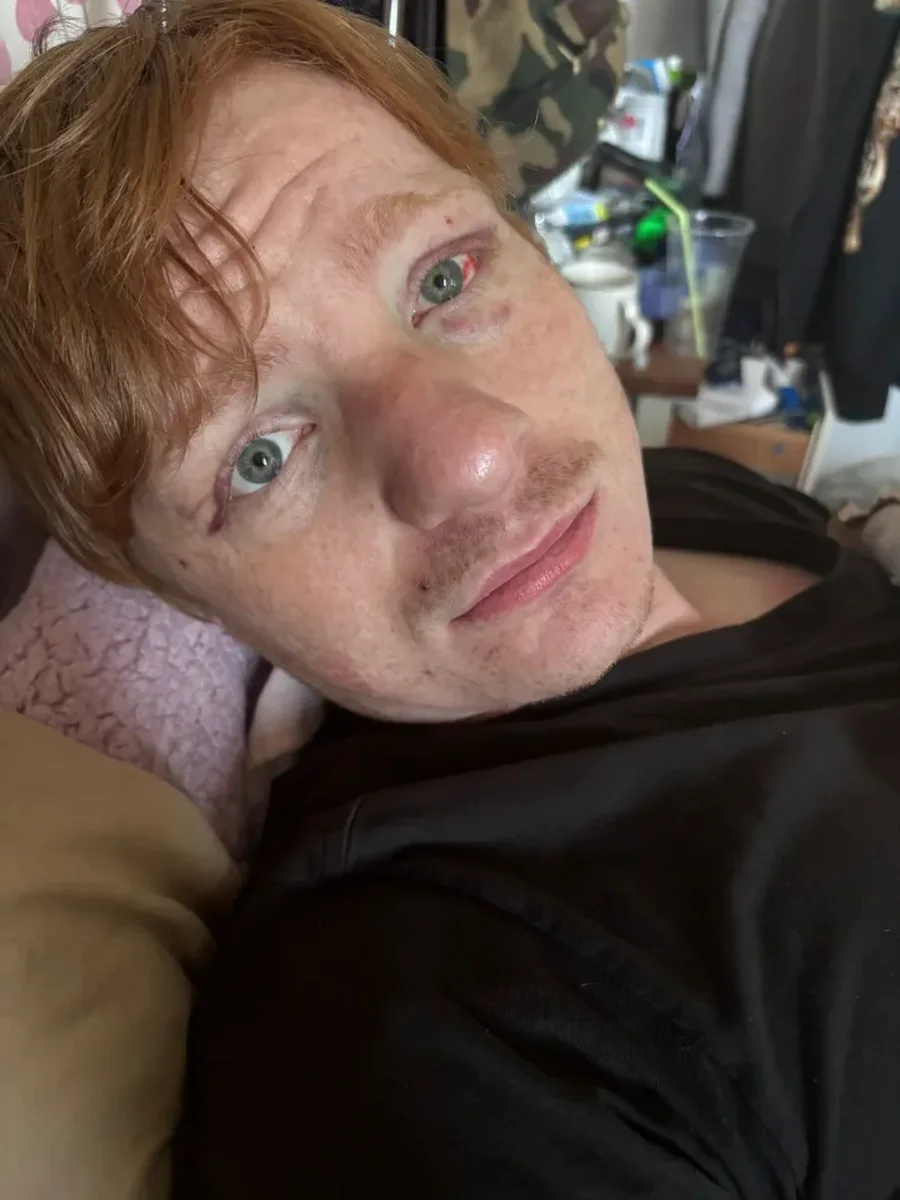 Sulmohet brutalisht sozia i Ed Sheeran: "Mendova se po vdisja"!