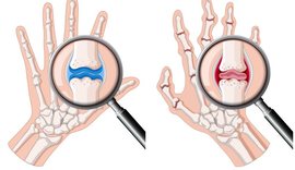A kam artrit apo artrozë? Ja si të dalloni këto dy probleme