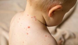 Diagnostikohet rasti i par&euml; me fruth n&euml; Shqip&euml;ri, i infektuar