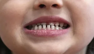 FDA kufizon përdorimin e suplementeve të fluorit për