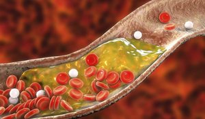 Një ilaç revolucionar oral ul ndjeshëm kolesterolin “e