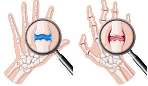 A kam artrit apo artrozë? Ja si të dalloni këto dy probleme