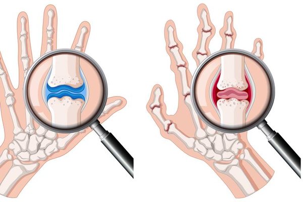 A kam artrit apo artrozë? Ja si të dalloni këto dy probleme