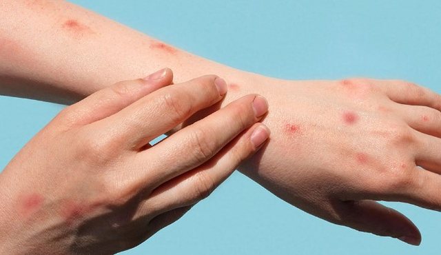 Rasti i parë i lisë së majmunit konfirmohet në