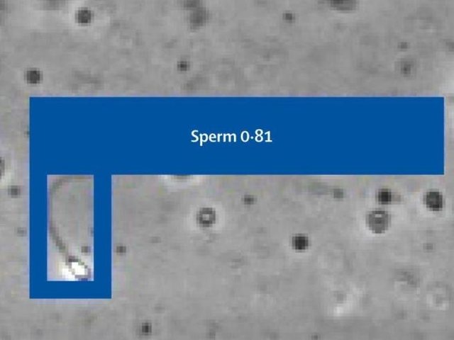 Sukses historik në SHBA: Inteligjenca artificiale ndihmon çiftin