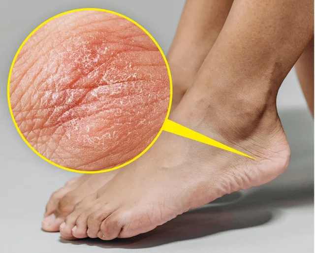 Çfarë ju tregojnë këmbët për shëndetin? 9