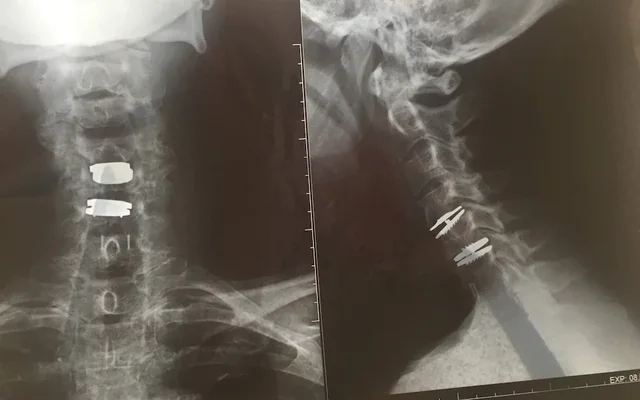 Një kirurg më paralizoi. Pastaj zbulova se isha një nga 200