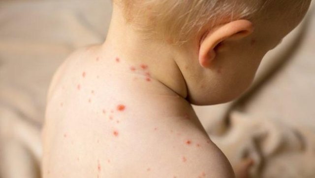 Diagnostikohet rasti i parë me fruth në Shqipëri, i infektuar