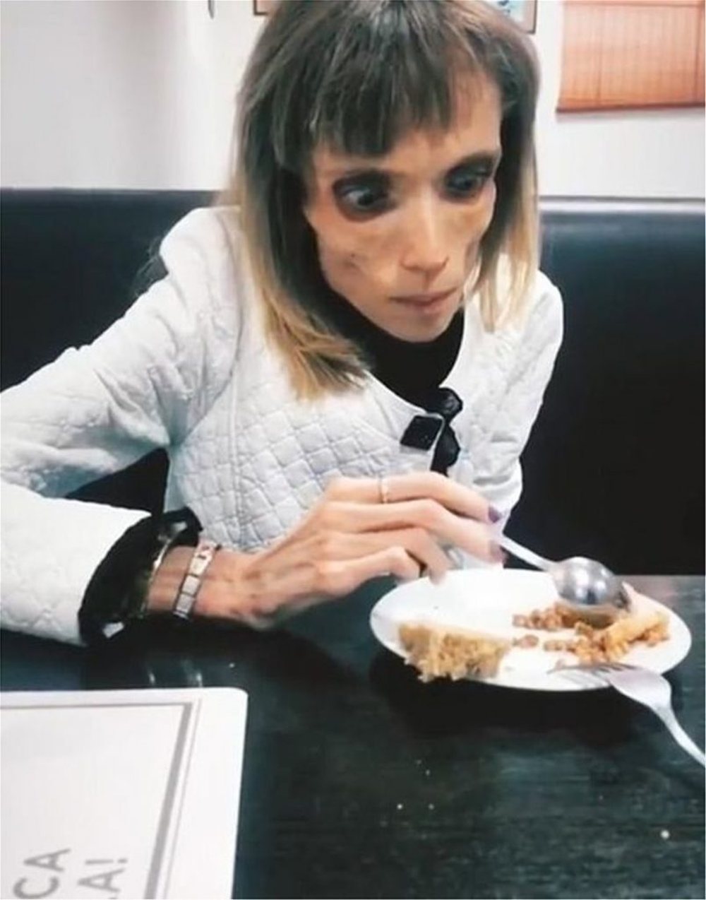 26-vje&ccedil;arja e ngjashme me zombie,shkak anoreksia