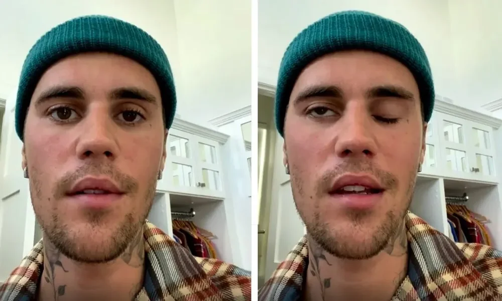 Justin Bieber zbulon detaje pas paraliz&euml;s s&euml; fytyr&euml;s