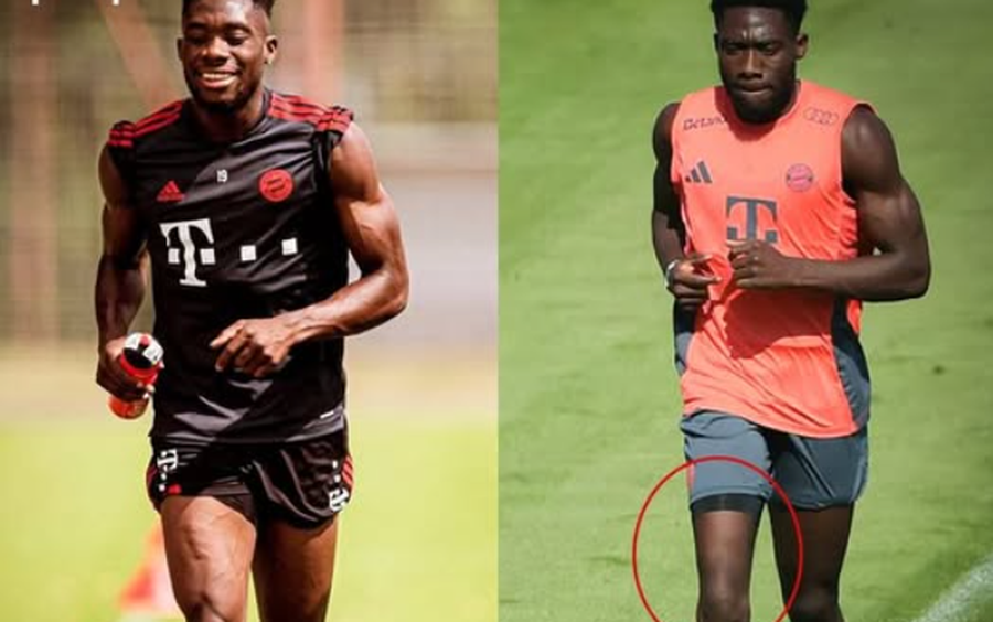 FOTO/ Alphonso Davies në gjendje të “rëndë”,