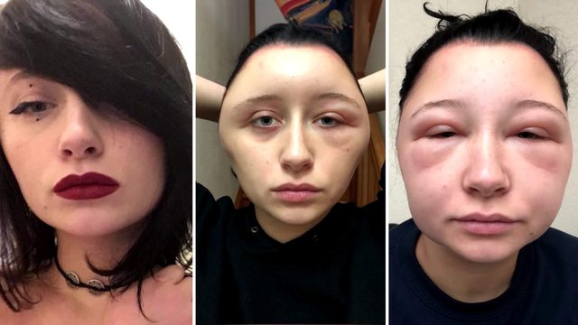 After hair dyeing, the 19-year-old wakes up in the morning with a deformed head