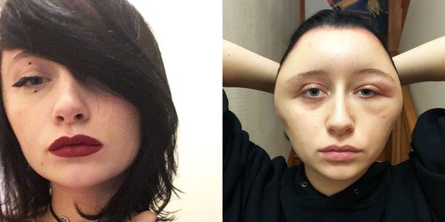 After hair dyeing, the 19-year-old wakes up in the morning with a deformed head