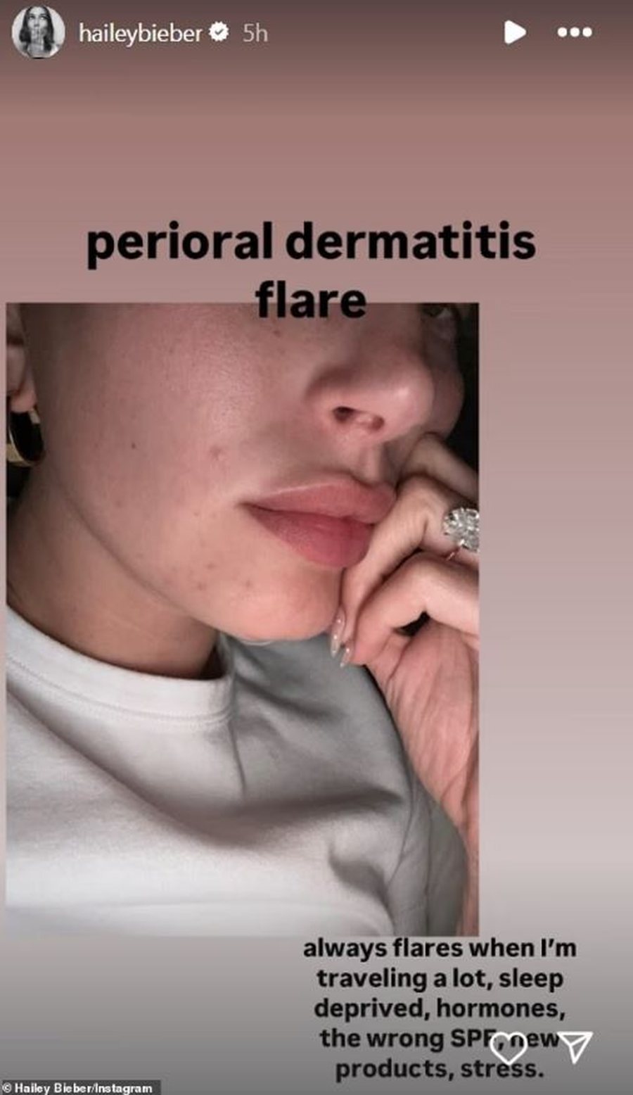 Hailey Bieber ndan një foto me ndjekësit: "Si ka ndikuar stresi