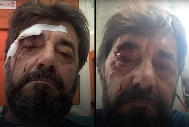 Dhunohet Ilir Demalia, analisti kall&euml;zon n&euml; polici: M&euml; sulmuan dy