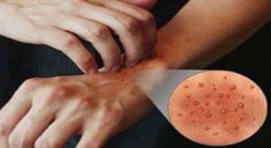 Italia në alarm, zgjebja po përhapet me shpejtësi