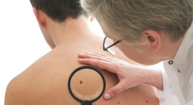 When a mole becomes a cause for concern - signs that should not be ignored