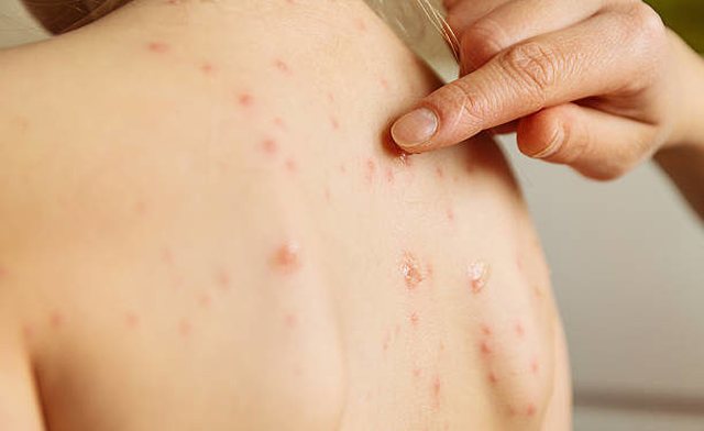First case of monkeypox identified in Albania