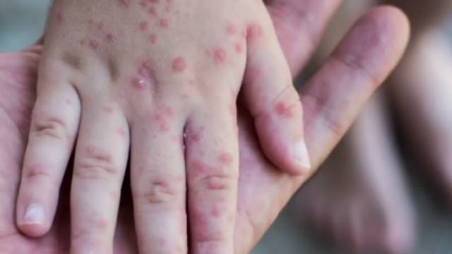 Has the young man affected by monkeypox infected others in Albania? IHP