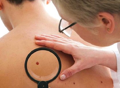 Why these are the days you should check your moles