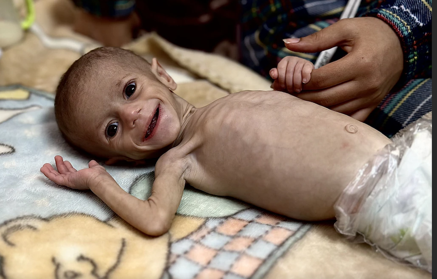 Historia e Siwar / Foshnja që u bë simbol i urisë në Gaza,