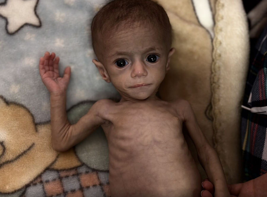 Historia e Siwar / Foshnja që u bë simbol i urisë në Gaza,