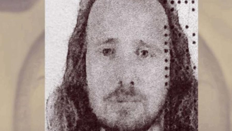 Bëri transplant flokët më pas edhe një ndërhyrje