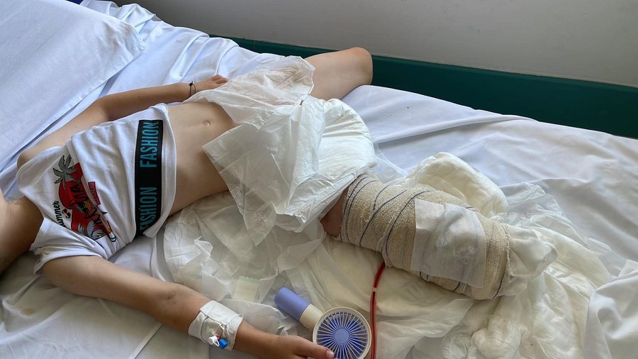 8-vjeçari humbi këmbën pas aksidentit në autostradë,