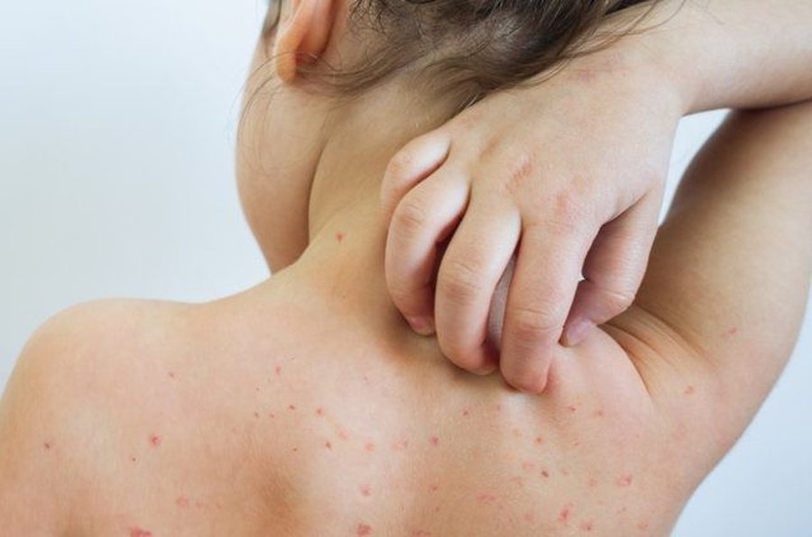 Nj&euml; f&euml;mij&euml; trevje&ccedil;ar infektohet me fruth n&euml;