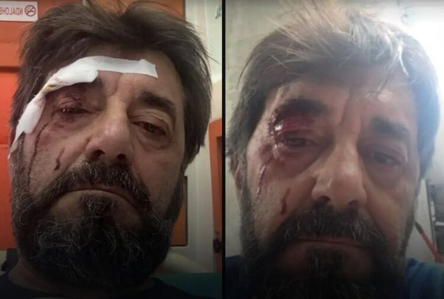 Dhunohet Ilir Demalia, gazetari kall&euml;zon n&euml; polici: M&euml; sulmuan dy